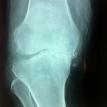 Severe Osteoarthritis knee