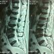 Compression fracture Spine