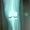Total Knee Replacement with long stem