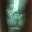 Supracondylar Fracture femur