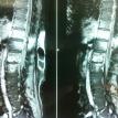 Osteomyelitis of the Spine